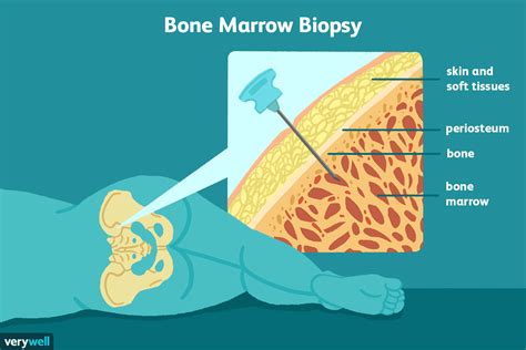 understanding bone marrow biopsy results|bone marrow biopsy recovery time.